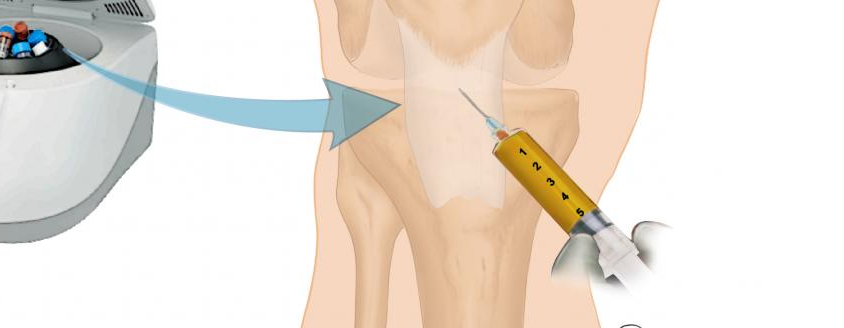 Immagine del trattamento al ginocchio