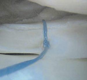 Foto artroscopica di una sutura meniscale eseguita con tecnica mini-invasiva