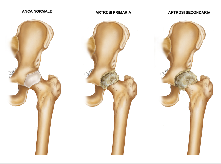 Fig. 1 - Confronto tra un’anca normale e un’anca artrosica
