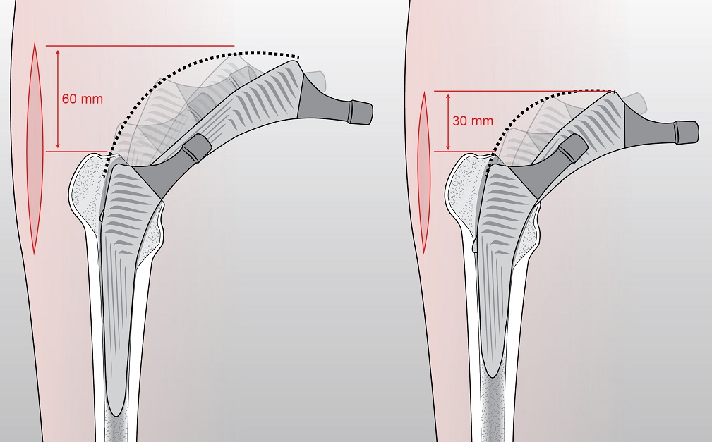 Esemplificazione del nuovo tipo di protesi (a destra) e relativa riduzione della lunghezza dell'incisione