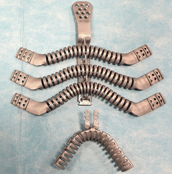 La protesi in titanio stampata in 3D impiantata