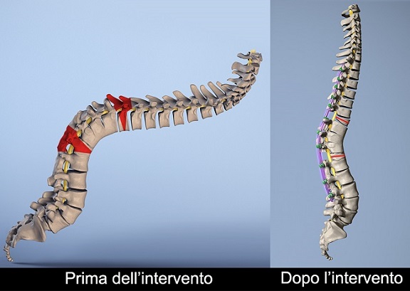 Prima e dopo l'intervento, ricostruzione della colonna vertebrale della paziente