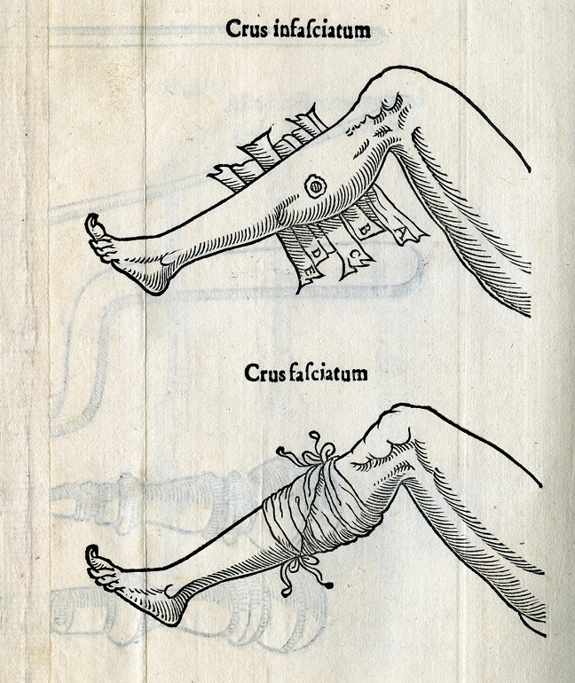Particolare di un'immagine tratta da Bartolomeo Maggi, De vulnerum sclopetorum, et bombardarum curatione tractatus, 1552