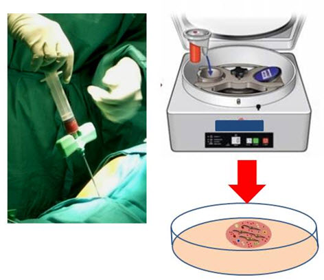 “One-step” bone marrow mononuclear cell transplantation in talar osteochondral lesions