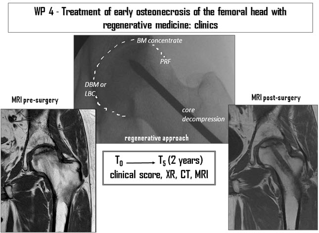Trattamento di osteonecrosi della testa del femore iniziali e avanzate tramite medicina rigenerativa
