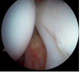 Fig. 2 Visione artroscopica del compartimento interno dell’anca