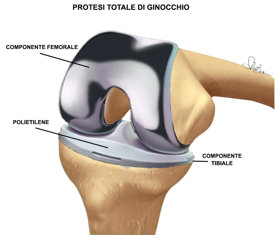 Fig. 4 - Protesi totale del ginocchio