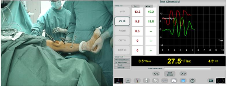Fig. 4 - Sistema di valutazioni cinematiche intra-operatorie navigate Fig. 4 - Sistema di valutazioni cinematiche intra-operatorie navigate