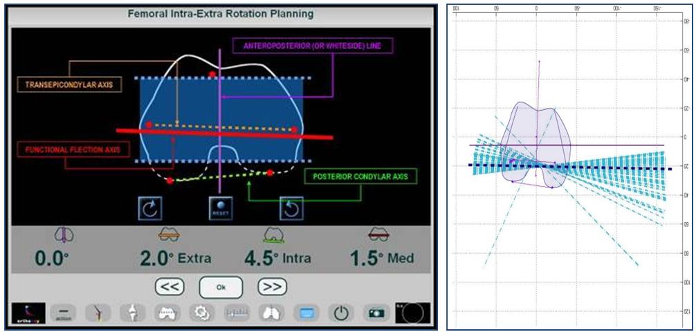 Fig. 5 – Sistema per la valutazione del posizionamento della componente protesica femorale per mezzo di valutazione funzionale dell’asse di flesso/estensione Fig. 5 – Sistema per la valutazione del posizionamento della componente protesica femorale per mezzo di valutazione funzionale dell’asse di flesso/estensione