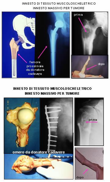 innesto tessuto 