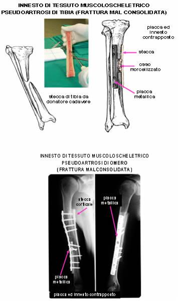 Innesto Tibia