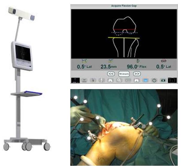 Fig. 1 – Software per l’intervento di protesi di ginocchio totale navigata Fig. 1 – Software per l’intervento di protesi di ginocchio totale navigata