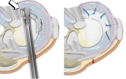 Sostituzione di lesione parziale del menisco interno con protesi meniscale bio-tecnoclogica (modified from: Zaffagnini et al, Syntetic Meniscal Scaffolds. Techniques in Knee Surgery, 2009;8(4):251-6).
