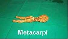 Metacarpi