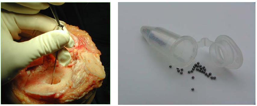 Fig. 1a-b: Impianto di marker nell’osso tramite cannule in acciaio (A) e marker in tantalio (B)