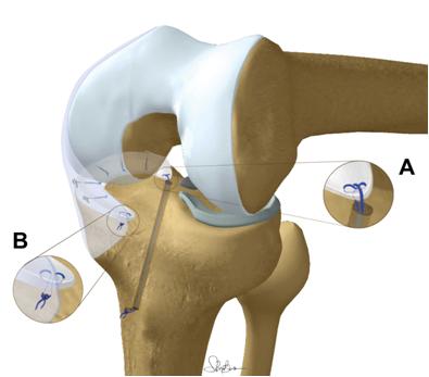 Tecnica mini-invasiva per il trapianto di menisco interno in artroscopia (reprinted from: Marcacci et al, Meniscal Allograft Transplantation Without Bone Plugs: A 3-Year Minimum Follow-up Study. Am J Sports Med, 2011; DOI: 10.1177/0363546511424688)