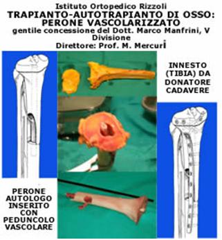 Trapianto Autotrapianto