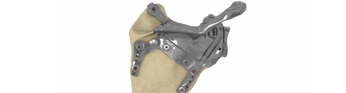 Protesi di scapola personalizzata realizzata in 3D