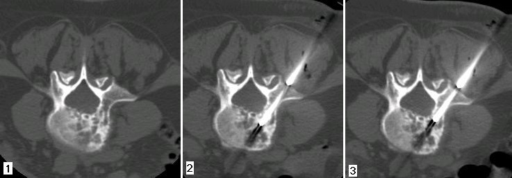 Immagini radiologiche agobiopsia