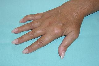 Artrite delle articolazioni metacarpofalangee (1a, 2a, 3a della mano destra) e deformità articolare del 5° dito della mano (cosiddetta a "collo di cigno") in paziente affetta da artrite reumatoide.