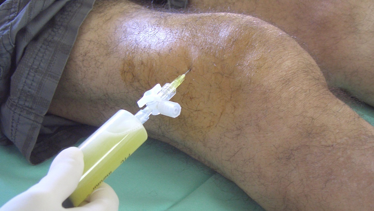 Artrocentesi di un ginocchio con aspirazione di liquido sinoviale di tipo infiammatorio in un paziente affetto da artrite reumatoide
