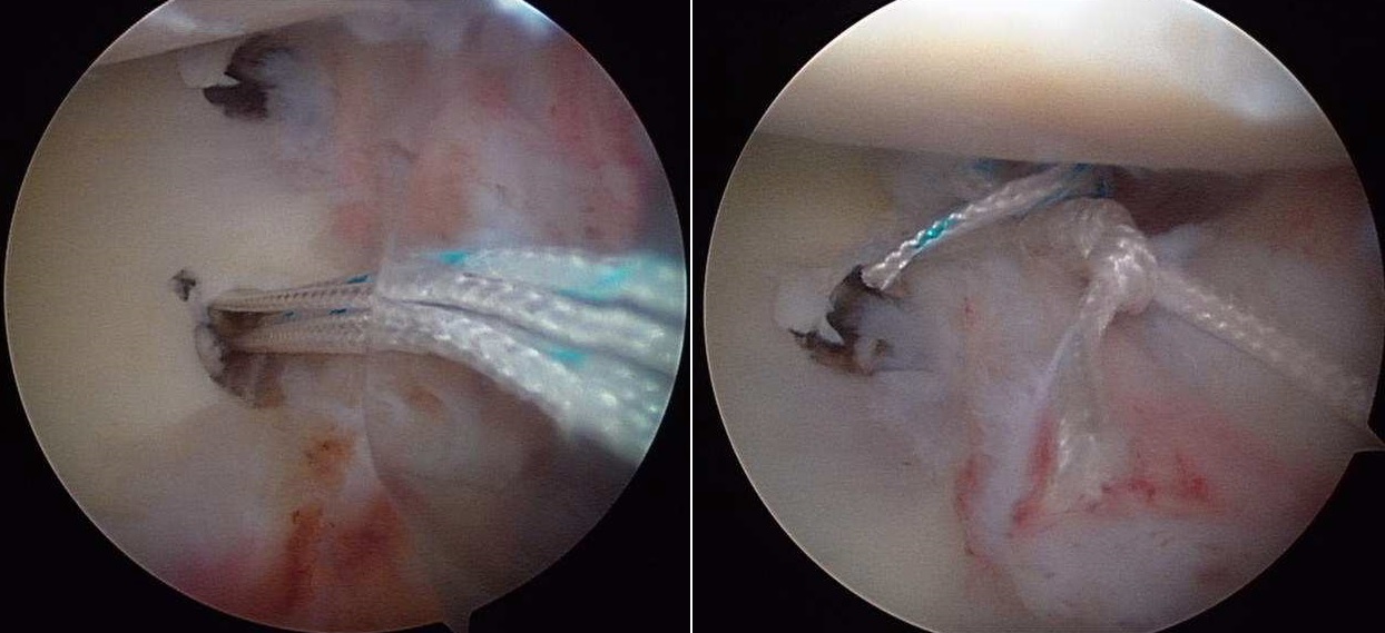 Fig. 3 - Immagini artroscopiche dell’intervento chirurgico.