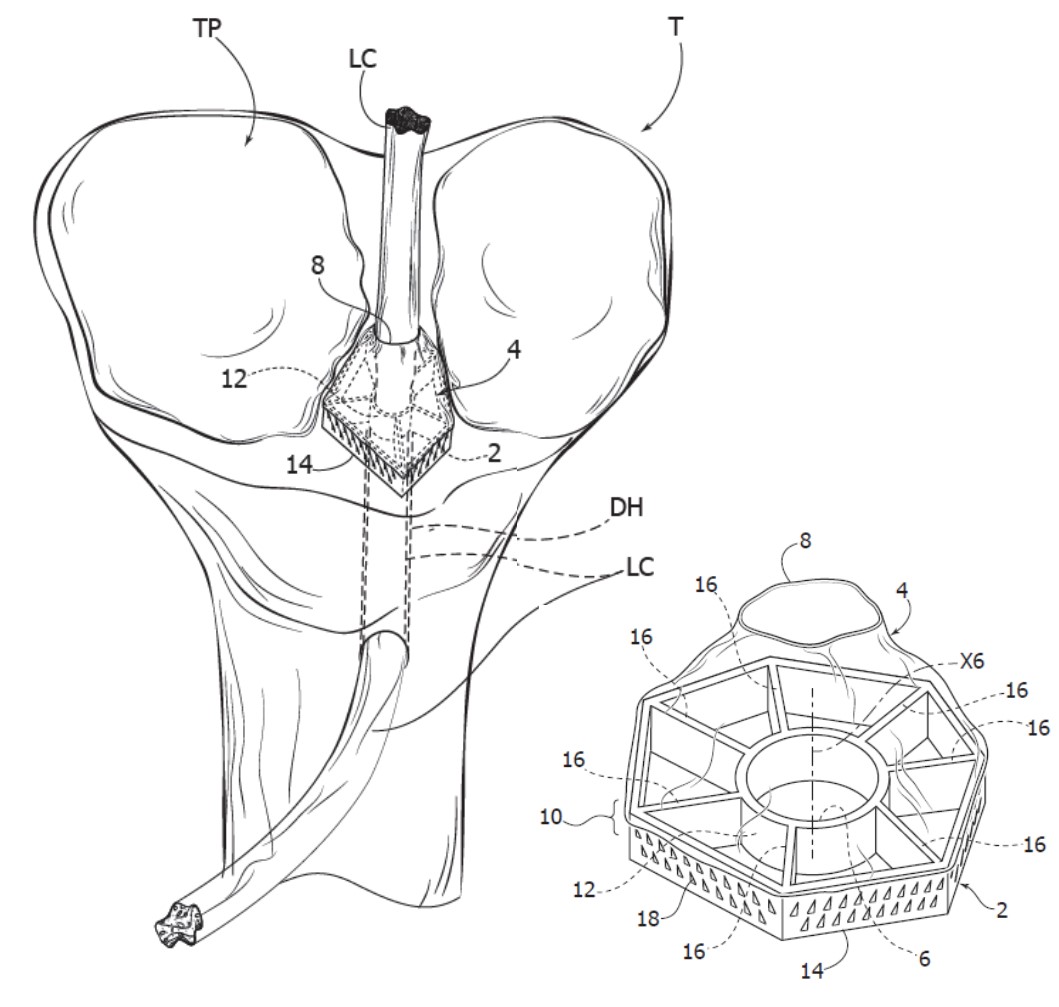 Immagine brevetto "Dispositivo per Intervento di Ricostruzione di un Legamento Crociato"