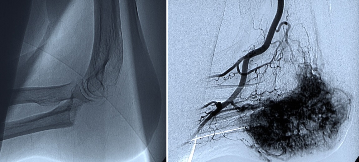 L’immagine radiologica (Fig. a sinistra) evidenzia la distruzione ossea da metastasi di un parte del gomito. L’immagine angiografica (Fig. a destra) mette in rilievo la vascolarizzazione patologica della lesione prima dell’embolizzazione.