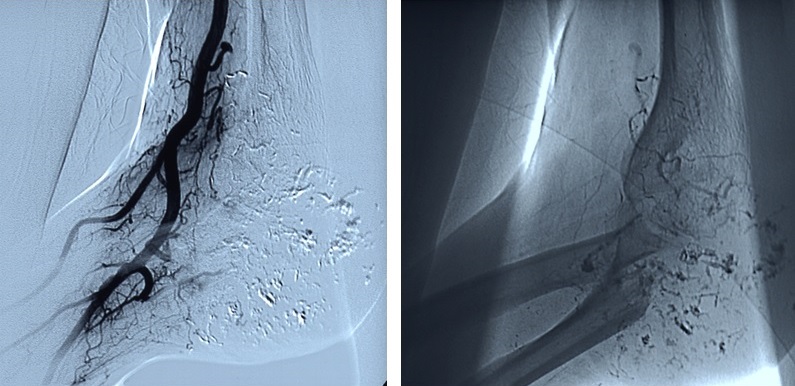 Le immagini dimostrano la scomparsa della vascolarizzazione patologica della metastasi dopo l’embolizzazione.