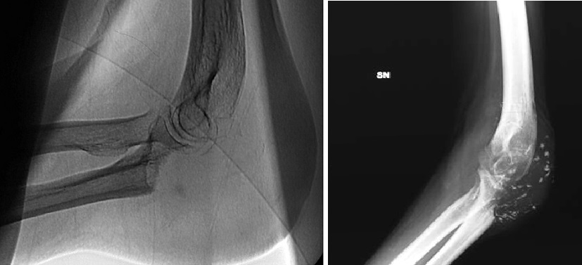 A distanza di 6 mesi dall'embolizzazione l'immagine radiografica del gomito (Fig. 5-6) mostra la significativa riduzione delle dimensioni della lesione. Ne consegue la scomparsa del dolore ed il ripristino della motilità articolare.