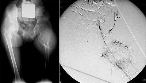 Lesione espansiva osteolitica del femore prossimale sinistro riferibile a cisti aneurismatica in bambina di 4 anni: radiografia (a sinistra) e arteriografia della lesione (a destra).