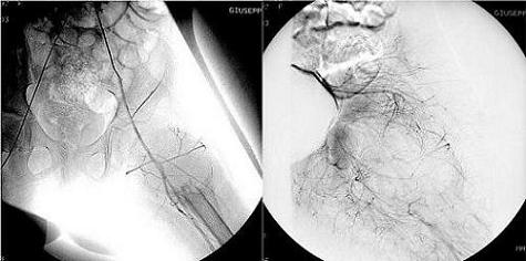 Arteriografia della lesione. A sinistra: immagine non sottratta. A destra: arteriografia della lesione dopo embolizzazione.