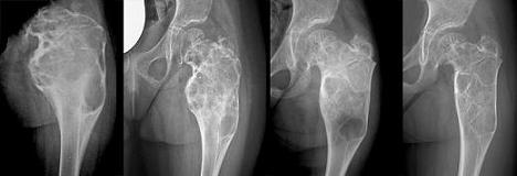 Sequenza di radiografie illustranti la fase intermedia di ristrutturazione ossea della lesione dopo l'embolizzazione.