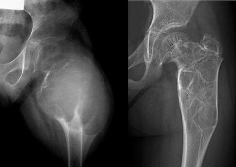 Situazione pre-embolizzazione (radiografia a sinistra) e fase di guarigione a 2 anni dall'embolizzazione (radiografia a destra).
