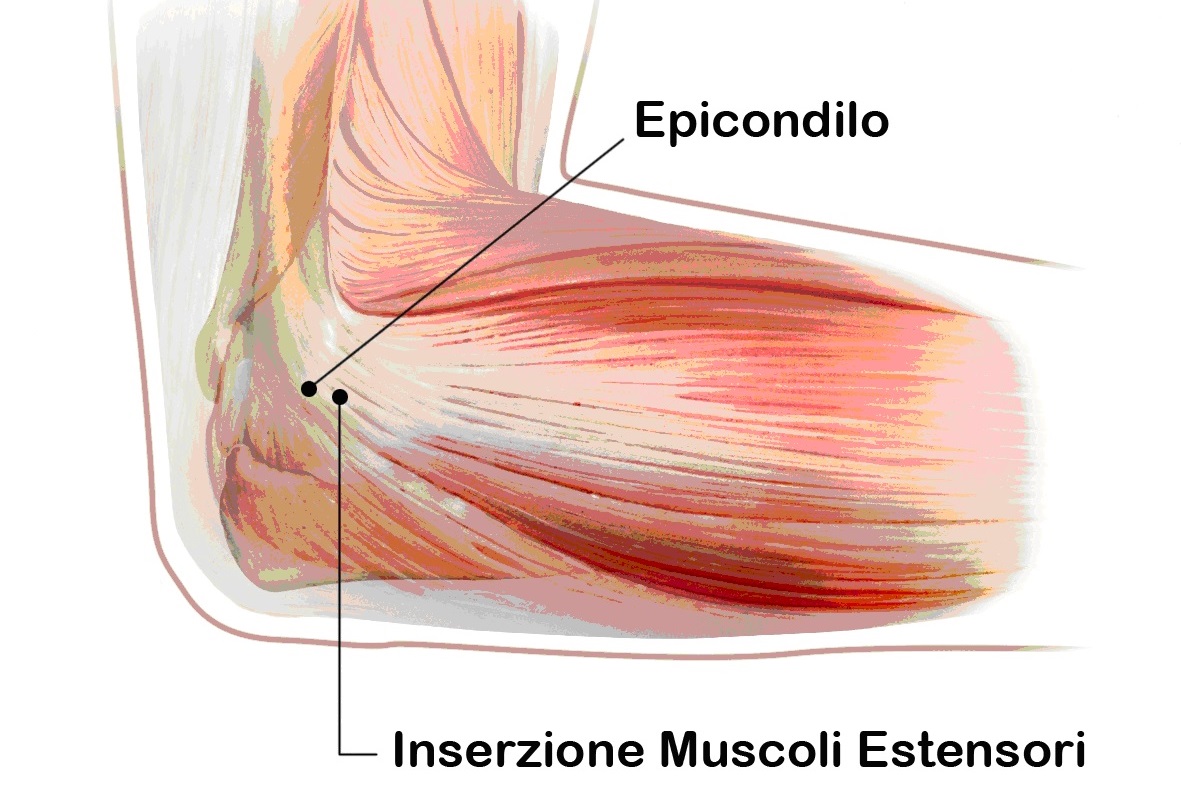 Fig. 1a - Rapporto tra inserzione dei tendini estensori del carpo ed epicondilo.