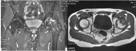 Figura 4: Tagli di Risonanza Magnetica di bacino, gold standard per la dignosi di necrosi avascolare dell’anca.