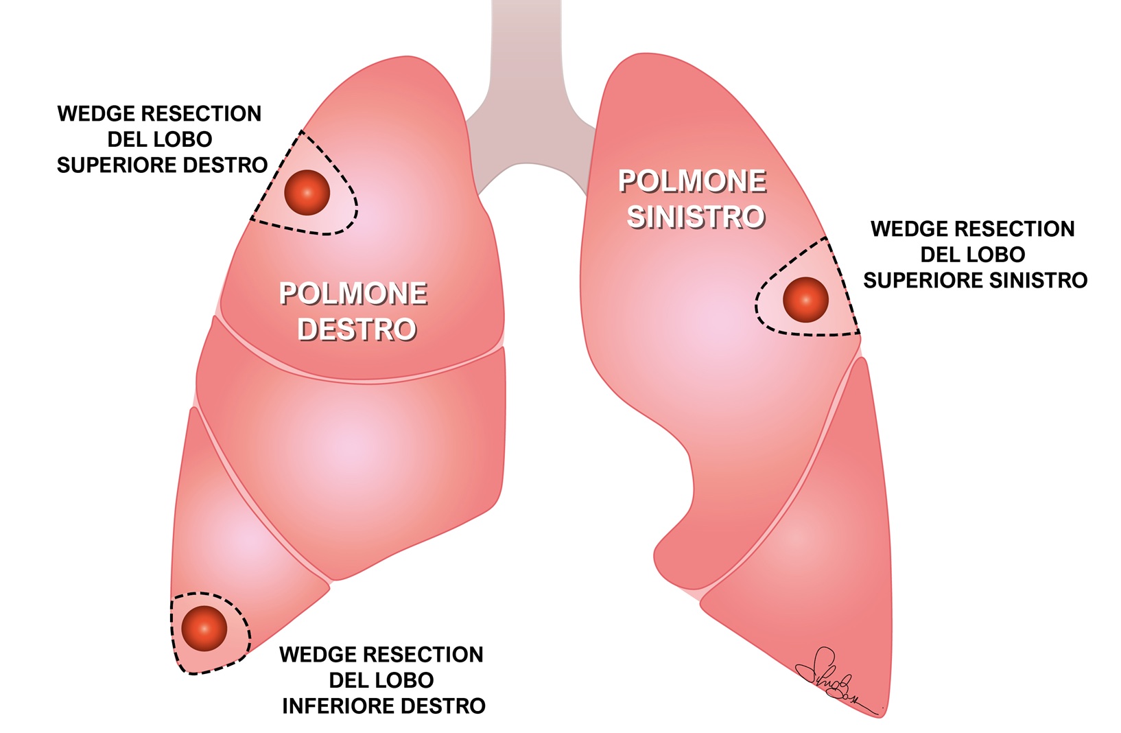 Figura 1: Rappresentazione schematica delle resezioni polmonari a cuneo (wedge resections) per metastasi polmonari