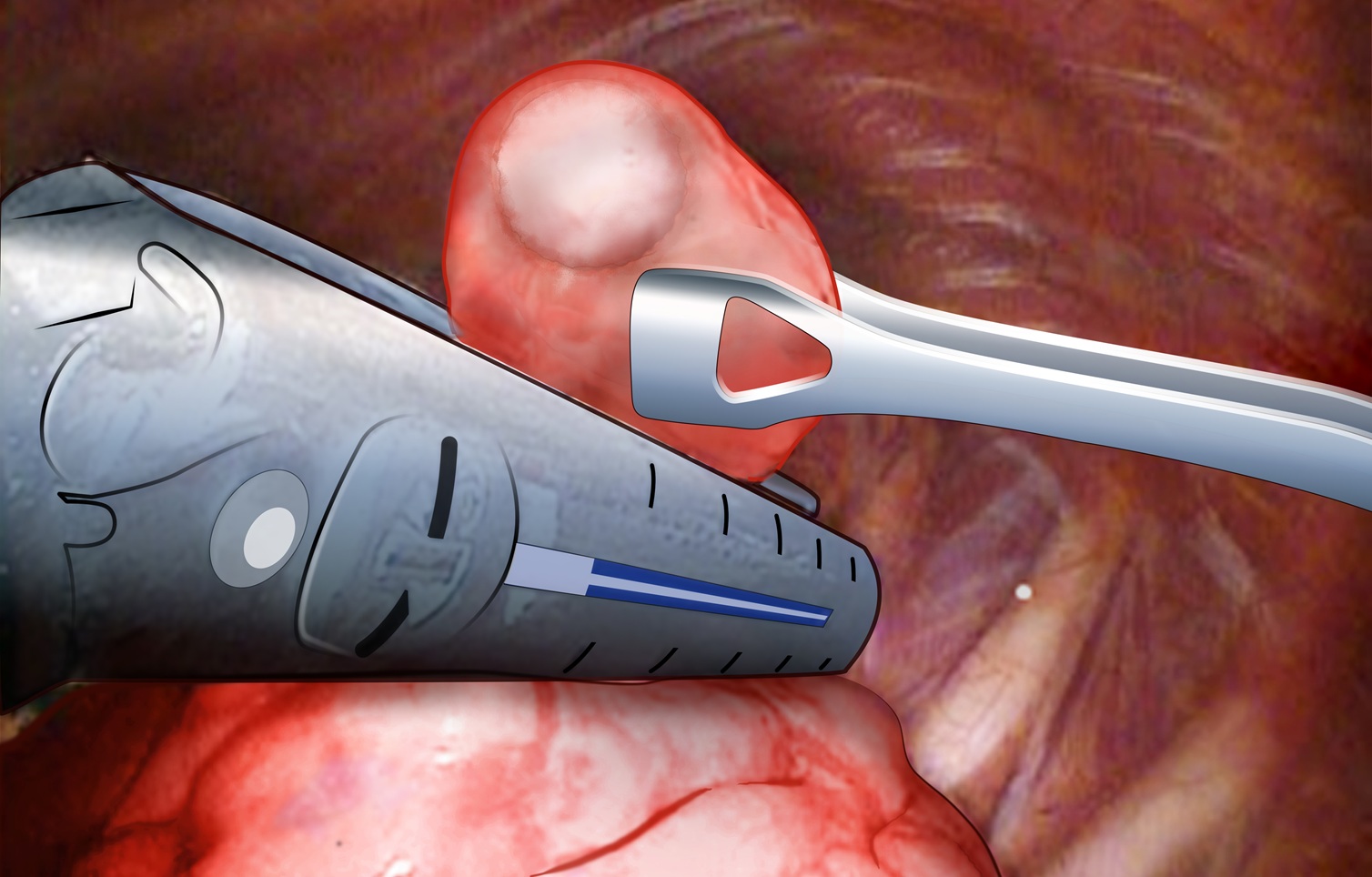 Figura 3: Resezione di metastasi polmonare mediante wedge resection eseguita con tecnica videotoracoscopica mini-invasiva