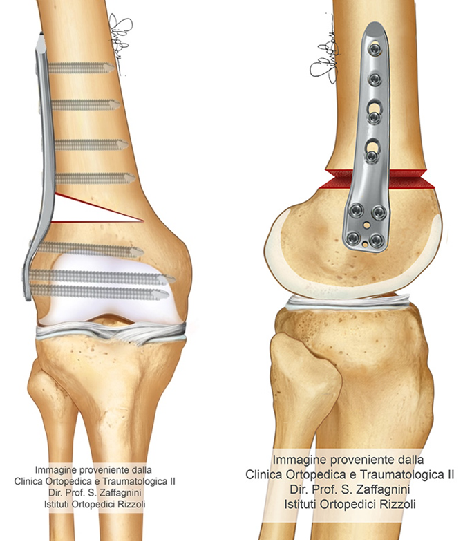osteotomia femorale laterale in apertura
