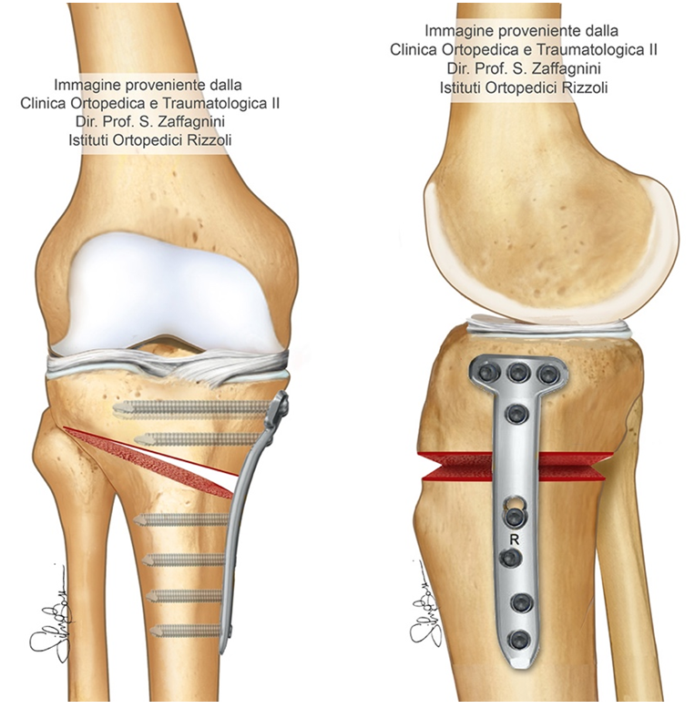 osteotomia tibiale mediale in apertura 