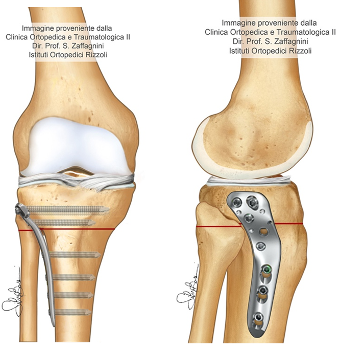 osteotomia tibiale laterale in chiusura 