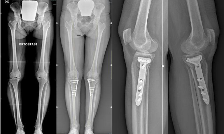 Radiografie degli arti inferiori in un paziente con ginocchia vare, confronto pre e post-operatorio in esiti di osteotomia tibiale valgizzante bilaterale.