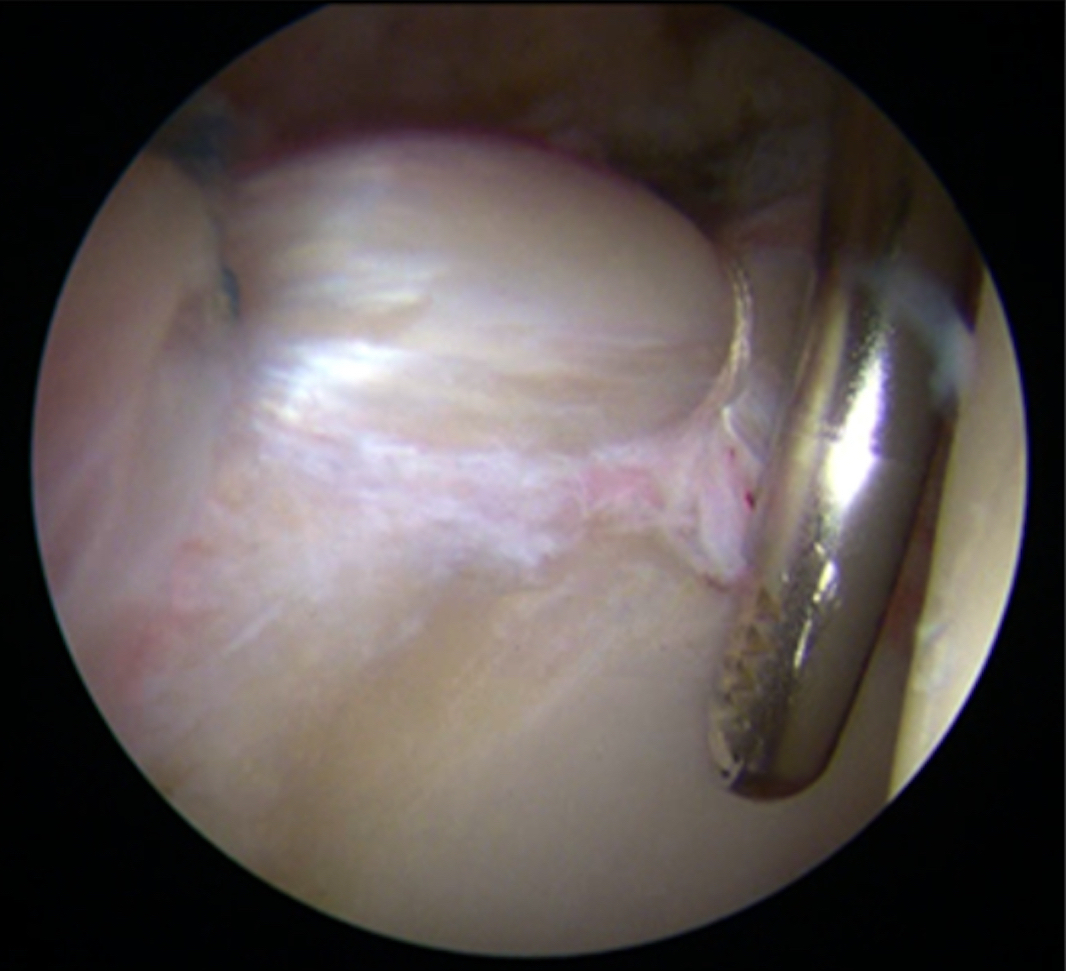 artroscopia dell’anca con riparazione del labbro acetabolare