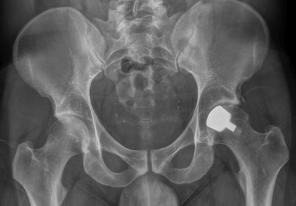 Radiografia di controllo