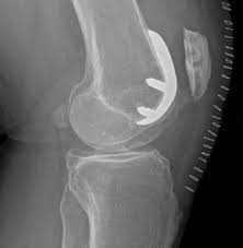 Fig. 5 - Controllo radiografico post-operatorio di una protesi femoro-rotulea