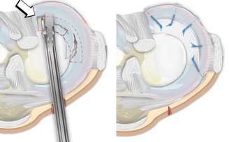 Sostituzione di lesione parziale del menisco interno con protesi meniscale bio-tecnoclogica (modified from: Zaffagnini et al, Syntetic Meniscal Scaffolds. Techniques in Knee Surgery, 2009;8(4):251-6).