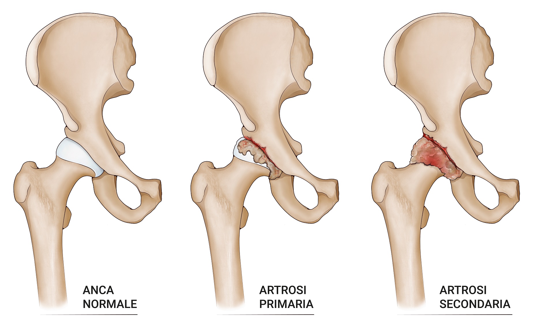 Anca normale ed anca artrosica