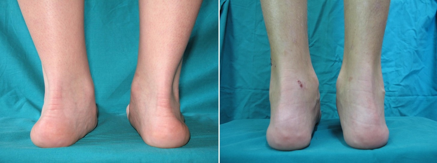 Piede piatto nel bambino: situazione pre-operatoria (a sinistra) e post-operatoria (a destra)
