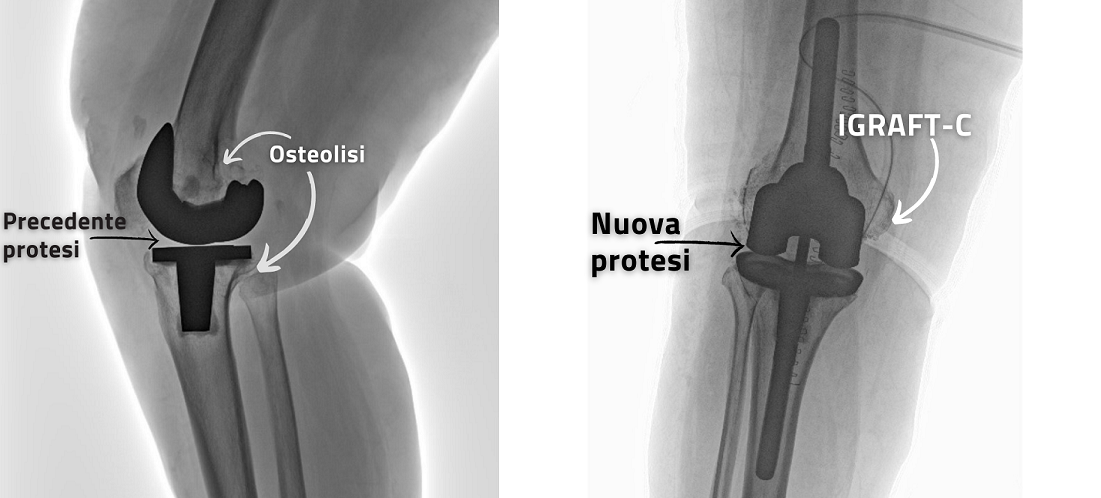 Radiografia del ginocchio di Anna, con la vecchia protesi (a sinistra) e con la nuova protesi e l'impiego della pasta IGRAFT-C