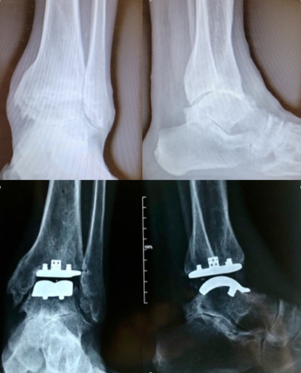 Radiografia dell'articolazione in un paziente prima e dopo l'impianto di una protesi di caviglia